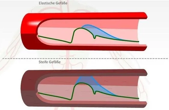 Steife Gefäße - GSK Venenzentrum Königstein im Taunus